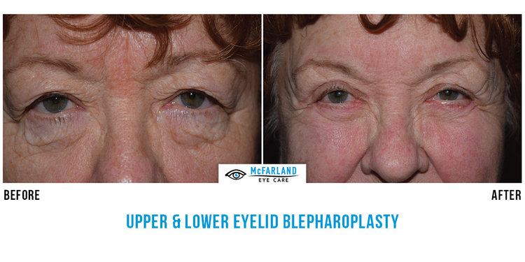 blepharoplasty before and after