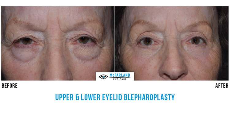 blepharoplasty before and after