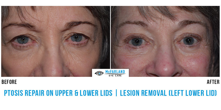 Ptosis Repair | Lesion Removal Before and After