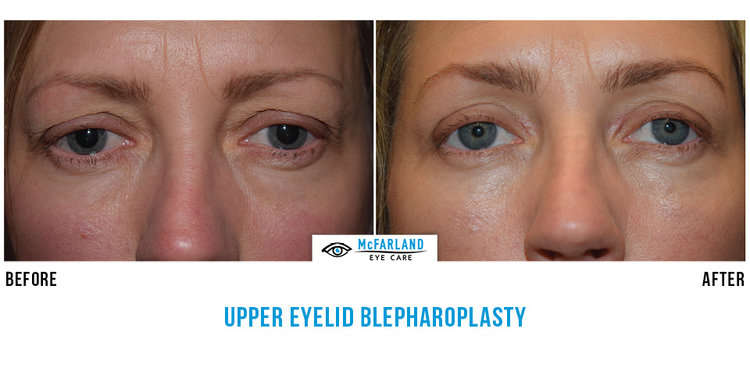 blepharoplasty before and after