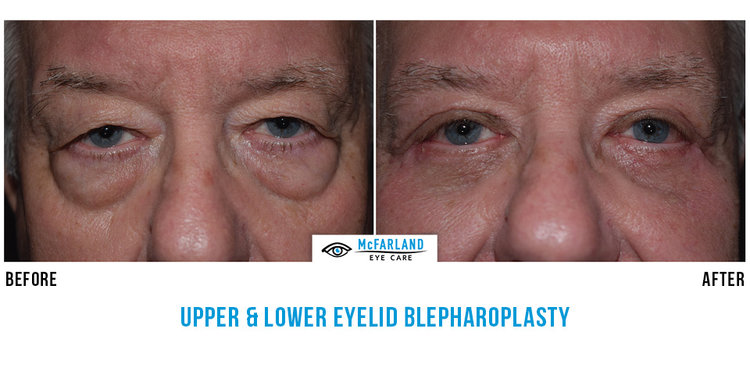 blepharoplasty before and after