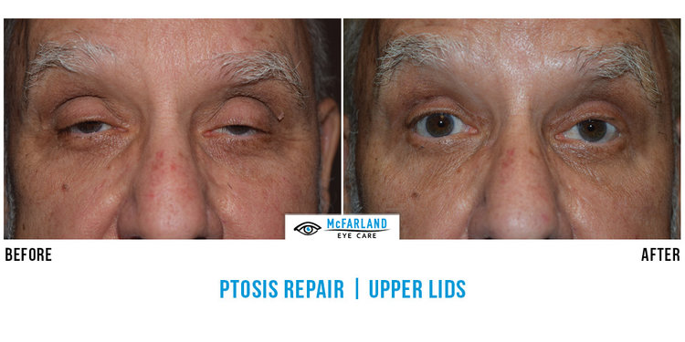 Ptosis Repair Before and After