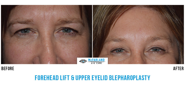 blepharoplasty before and after