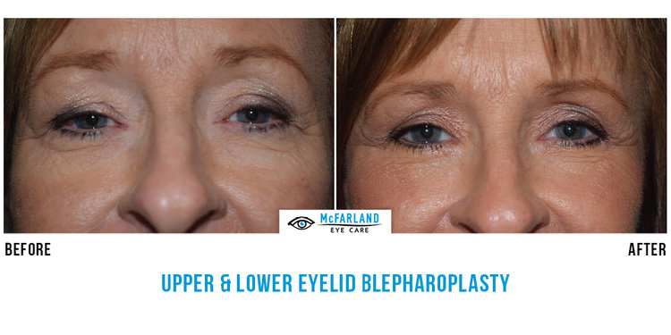 blepharoplasty before and after