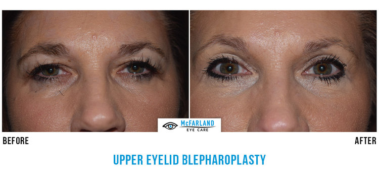 blepharoplasty before and after