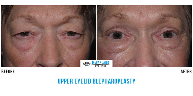 blepharoplasty before and after