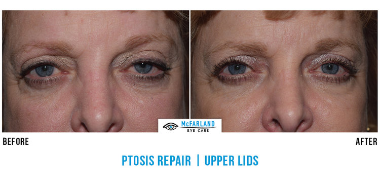 Ptosis Repair Before and After