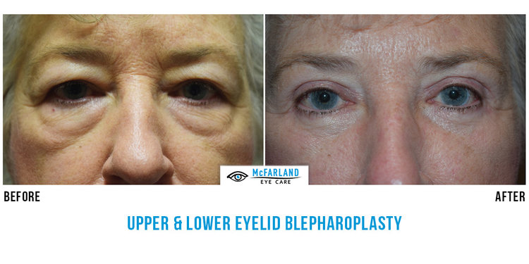 blepharoplasty before and after