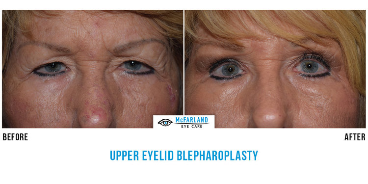 blepharoplasty before and after