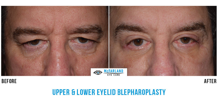 blepharoplasty before and after