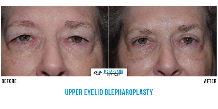 blepharoplasty before and after