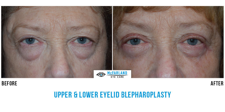 blepharoplasty before and after