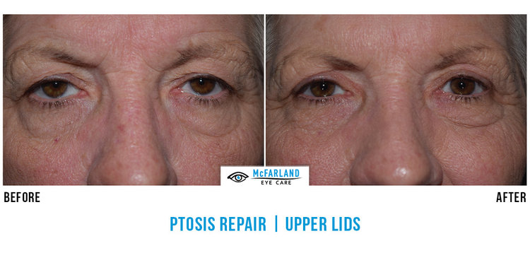 Ptosis Repair Before and After