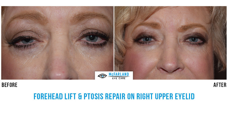 Forehead lift and Ptosis repair before and after