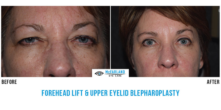 blepharoplasty before and after