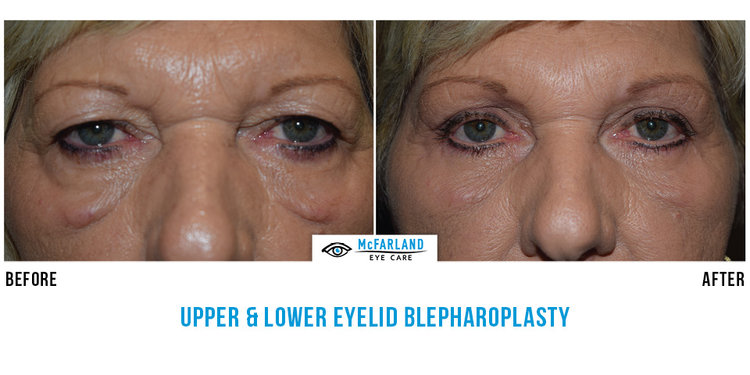 blepharoplasty before and after