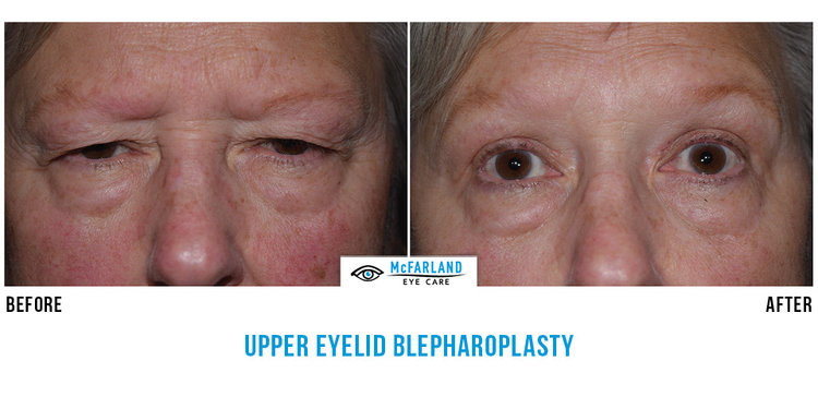 blepharoplasty before and after