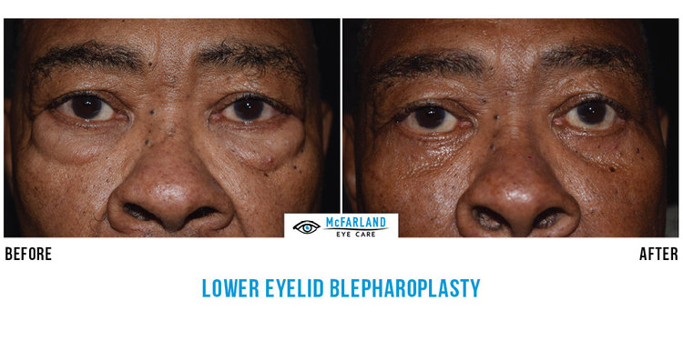 blepharoplasty before and after