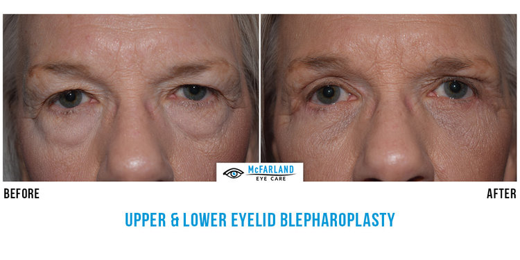 blepharoplasty before and after