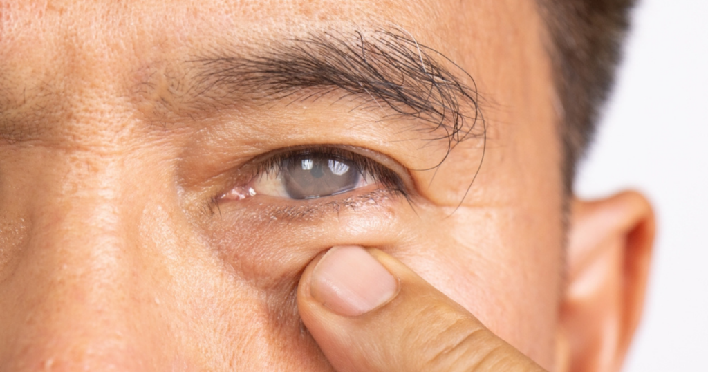 Close-up of an eye affected by a cataract, showing a cloudy natural lens that can cause blurred vision, glare, and reduced visual clarity.