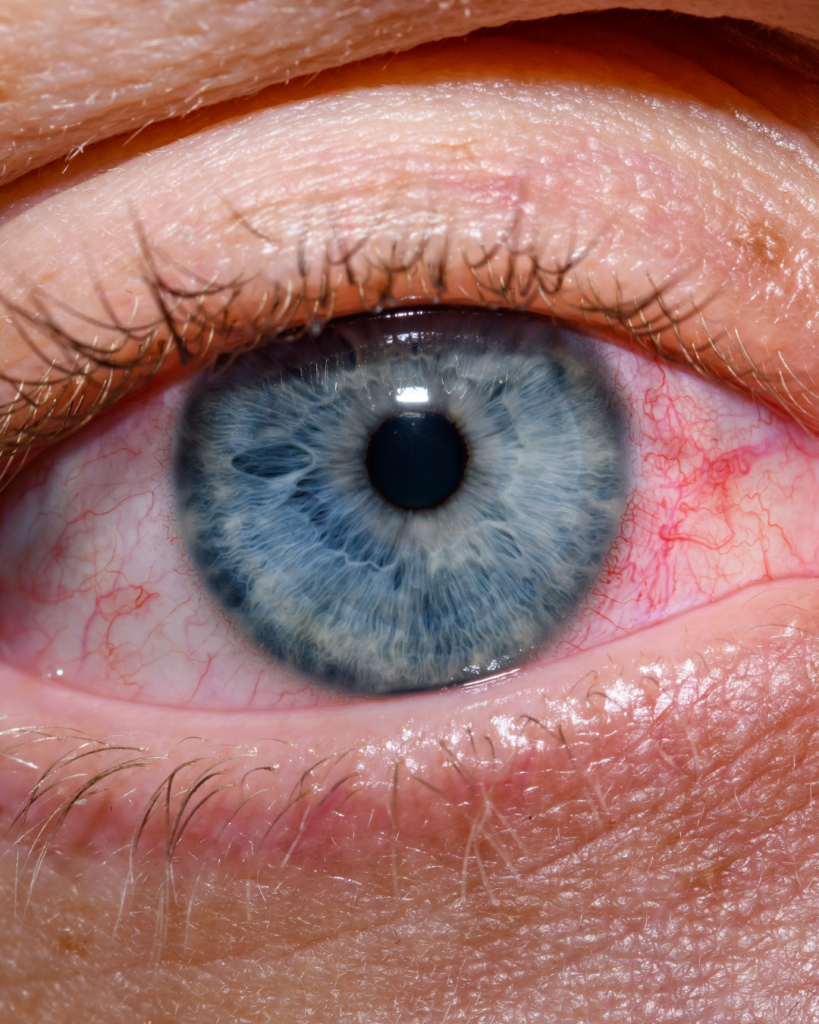 Close-up image of a red, irritated blue eye with visible blood vessels caused by eye allergies and seasonal allergy irritation.