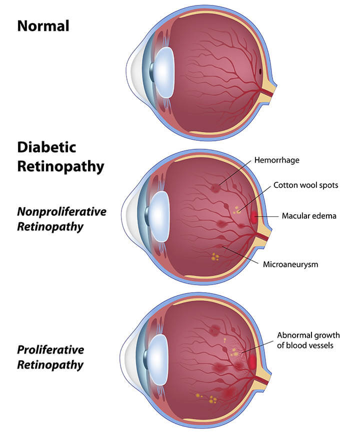 Chart Illustrating a Normal Eye Compared to One With Diabetic Retinopathy