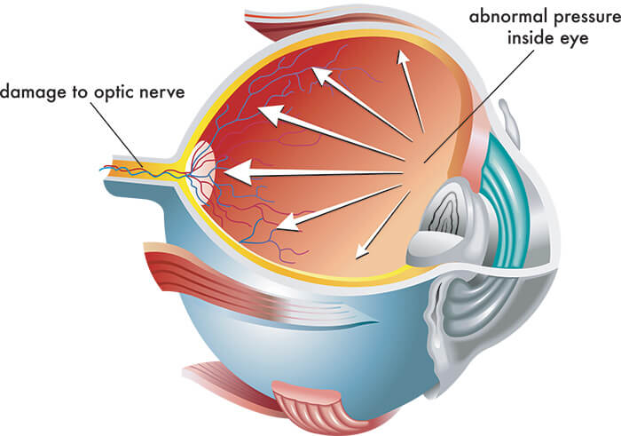 Chart Illustrating abnormal pressure inside an eye, with damage to the optic nerve