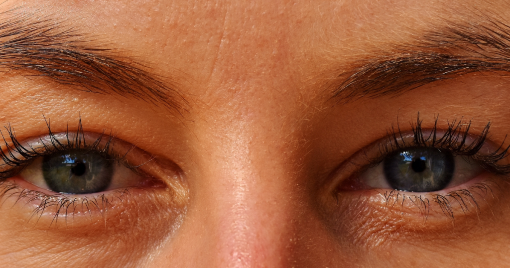 Close-up of a woman’s irritated, red eyes.