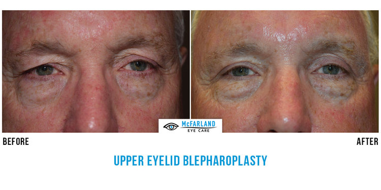 blepharoplasty before and after