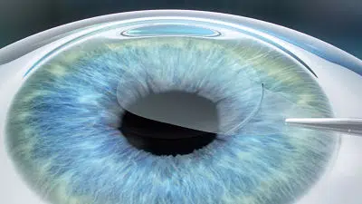 Eye Surgery With refractive lens exchange